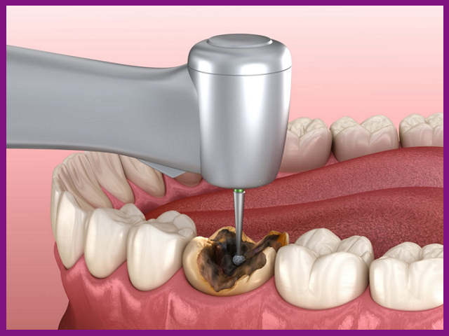 răng sâu sẽ giúp tạo điều kiện cho vi khuẩn có hại thâm nhập vào tủy răng dễ dàng hơn
