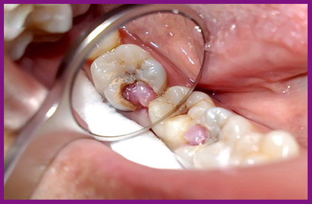 sâu răng là nguyên nhân gây viêm tủy răng
