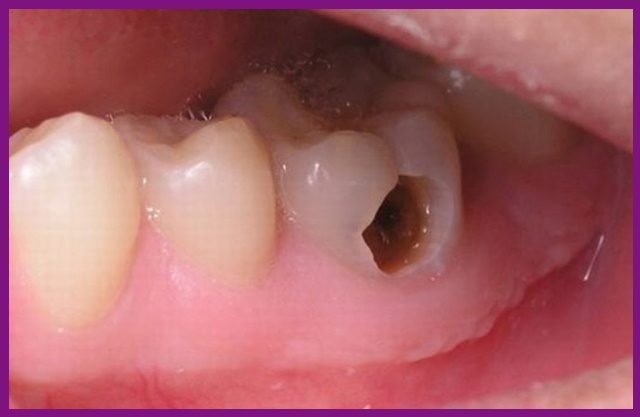 sâu răng ăn sâu vào tủy sẽ tạo nên nguy cơ mất răng vĩnh viễn rất cao