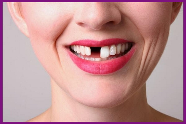 nếu không điều trị đau tủy răng kịp thời sẽ khiến cho nguy cơ bị mất răng thật rất cao