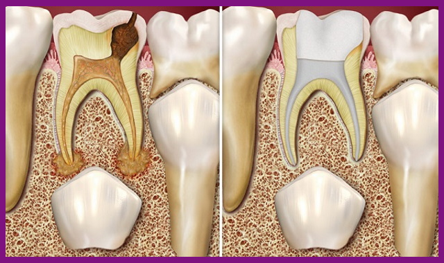 sâu răng là một trong những nguyên nhân gây ra viêm chóp răng