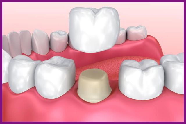 bọc răng sứ sẽ làm tăng tính thẩm mỹ cho răng