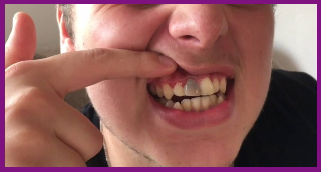 răng đổi màu đen xám là dấu hiệu của viêm nhiễm ở tủy