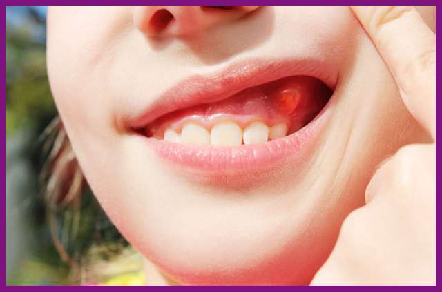 vùng lợi xuất hiện các nốt nổi lên mụn, báo hiệu tủy răng của bạn đang gặp vấn đề nghiêm trọng