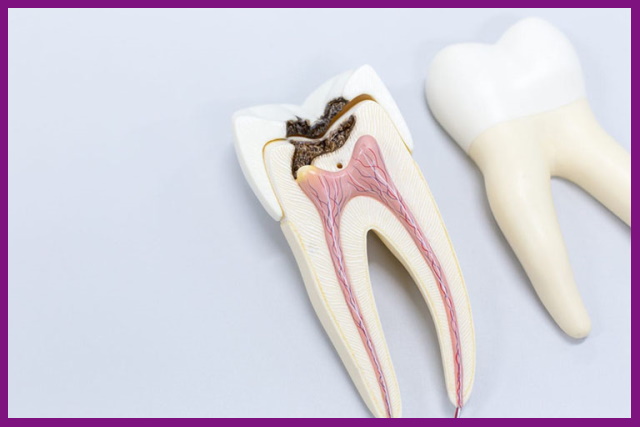 vi khuẩn thông qua các lỗ sâu răng và gây viêm ở tủy