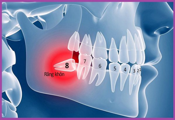 có nên nhổ răng số 8 hàm trên không