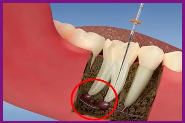 thực hiện lấy tủy răng là cách nhanh nhất để giảm bớt những cơn đau do tủy răng gây ra