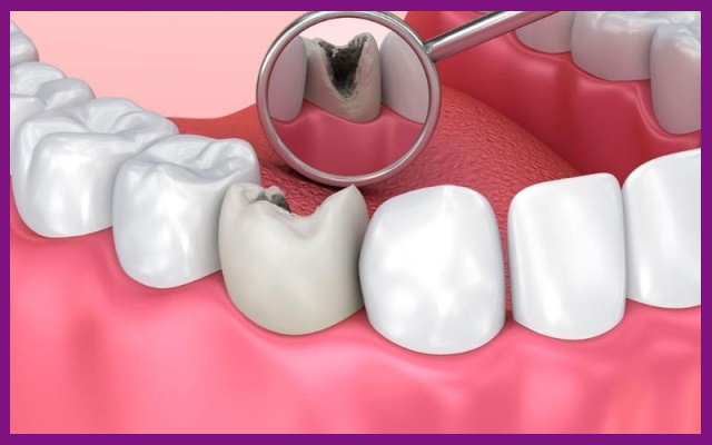 răng sâu là tác nhân gây ra bệnh đau ở tủy răng