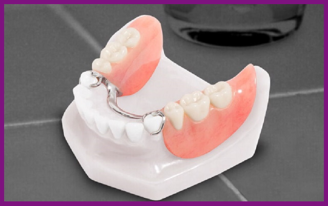 răng giả tháo lắp có chi phí thấp, thích hợp với nhiều người