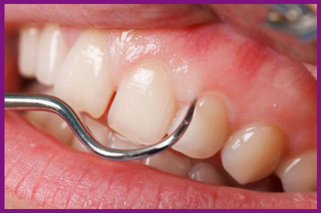 các bệnh về răng miệng sẽ được hạn chế rất nhiều nhờ phục hình răng giả