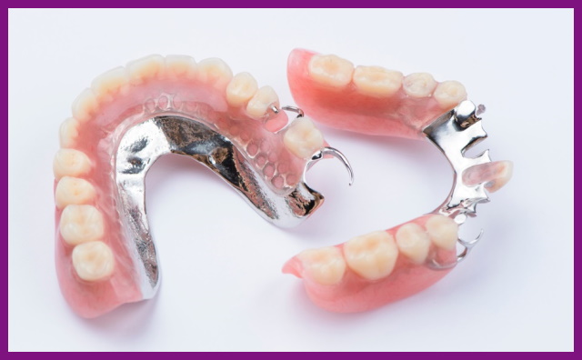 tháo lắp hàm khung thích hợp với nhiều trường hợp mất răng khác nhau