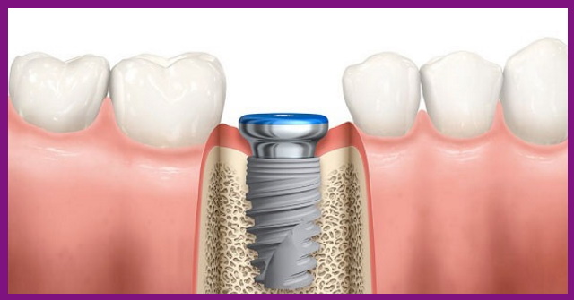 trụ implant khi tích hợp hoàn toàn vào xương hàm sẽ tồn tại trong răng miệng của bệnh nhân có khi lên đến suốt đời