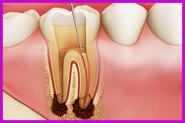 điều trị lấy tuỷ răng