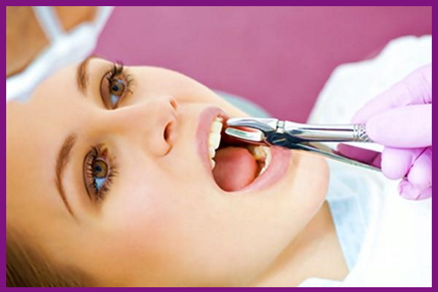 nhổ răng sẽ dành cho những trường răng bị sâu nặng, tủy răng đã bị hoại tử hoàn toàn