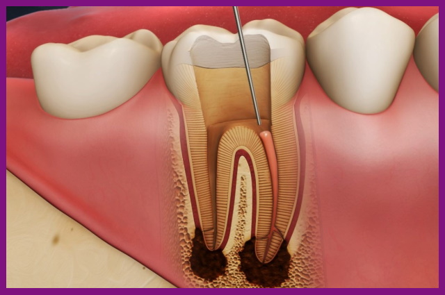 sâu răng đã ăn sâu vào tủy thì cách điều trị tốt nhất là lấy tủy kết hợp trám bít