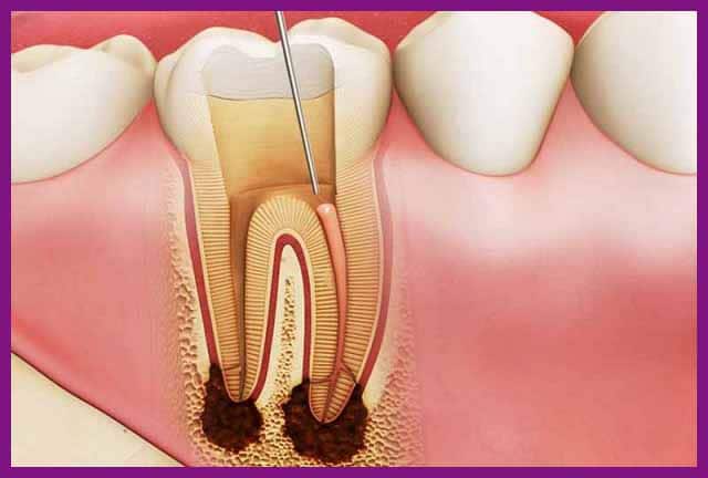 điều trị tuỷ răng số 7