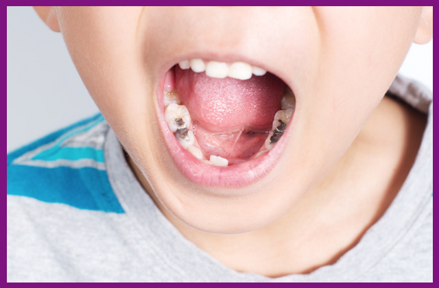 giá điều trị tủy răng phụ thuộc vào vị trí răng