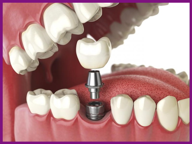 bằng việc cấy trực tiếp trụ implant vào xương hàm, nên răng sứ implant sẽ không gây ảnh hưởng đến các răng kế cận