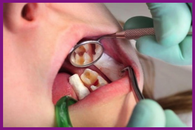 tác nhân chính gây viêm tủy răng là sâu răng