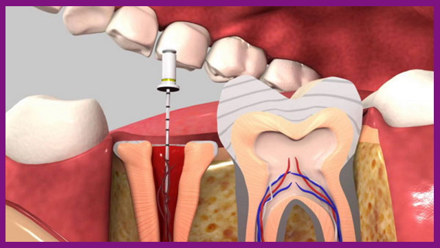 lấy tủy răng là phương pháp an toàn và hiệu quả để loại trừ viêm nhiễm trong tủy răng