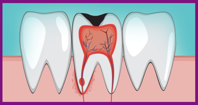 tủy răng bị viêm bắt nguồn từ các lỗ sâu trên răng