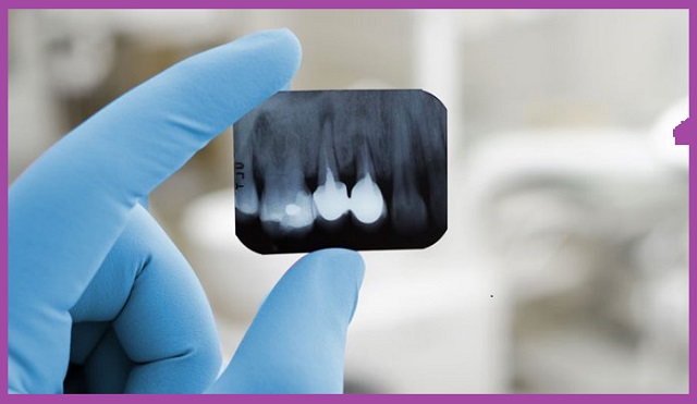 máy nhổ răng siêu âm Piezotome giảm đau