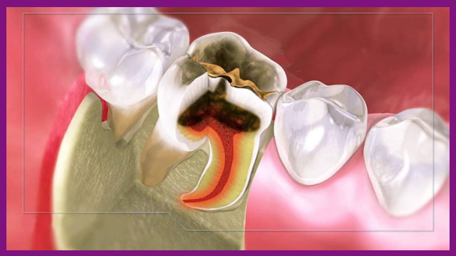 nguyên nhân gây đau tủy răng là do sâu răng ăn vào trong tủy răng