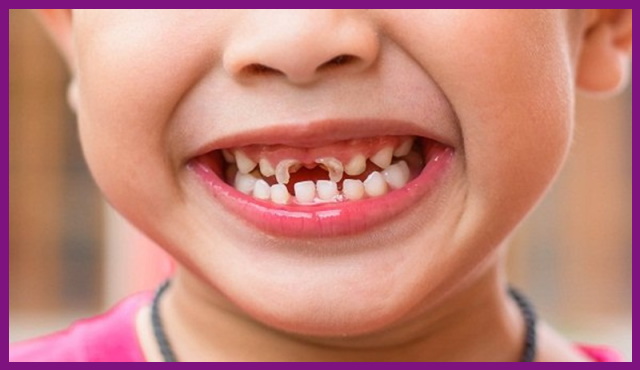 sâu răng là nguyên nhân hàng đầu gây viêm tủy răng ở trẻ nhỏ