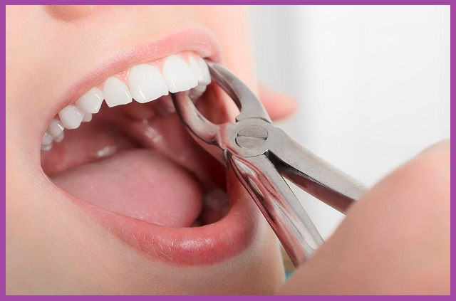 nhổ răng hàm không đau tại xo