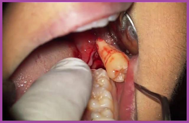 nhổ răng hàm tại tphcm