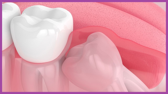 nhổ răng khôn có bảo hiểm tại tphcm