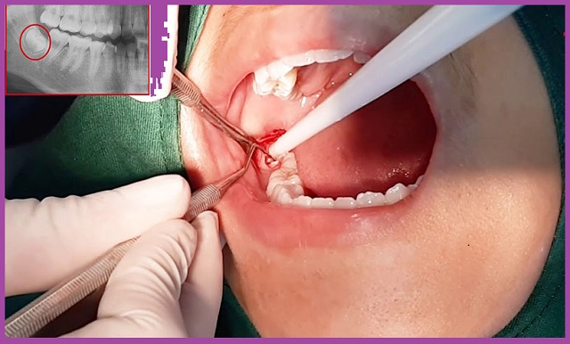 nhổ răng khôn hàm trên có nguy hiểm không tại nha khoa xo