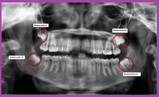 nhổ răng khôn hàm trên có nguy hiểm không tại xo