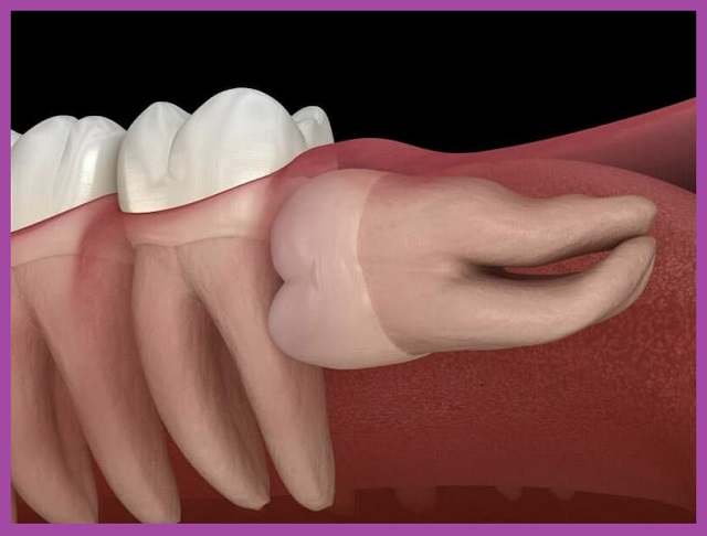 nhổ răng nào nguy hiểm nhất tại tphcm
