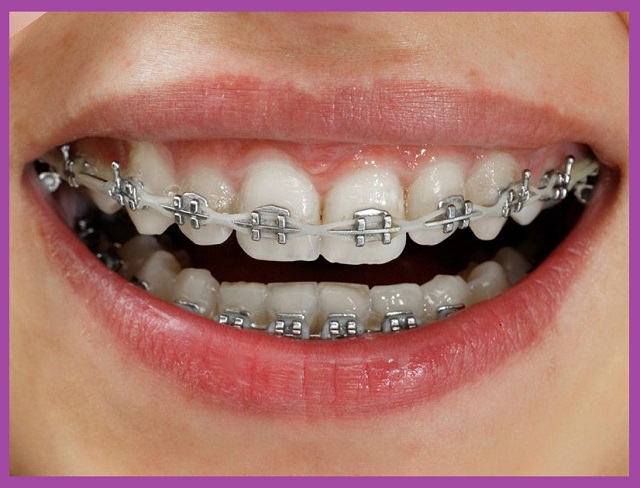 niềng răng có cần nhổ răng không tại nha khoa xo