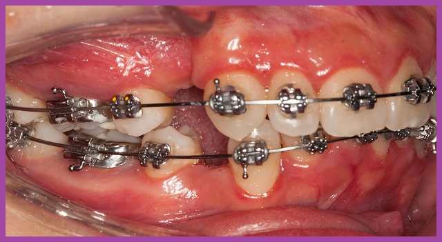 niềng răng phải nhổ răng tại tphcm