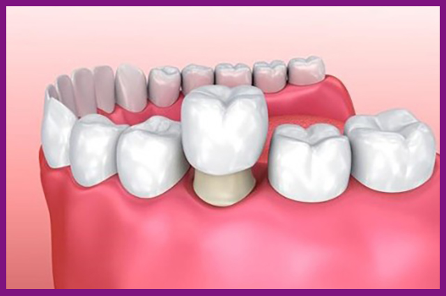 Phuc hình răng cố định là gì 