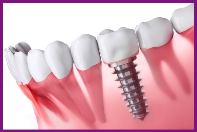 trồng răng implant bền nhất, có tuổi thọ gần như suốt đời