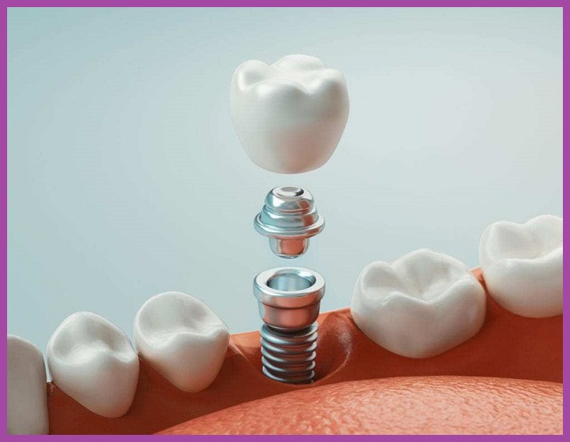 phục hình răng Implant tại tphcm