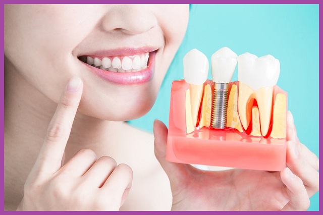 phục hình răng Implant