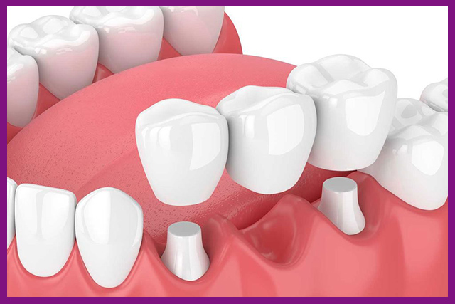 Phục hình răng là gì?