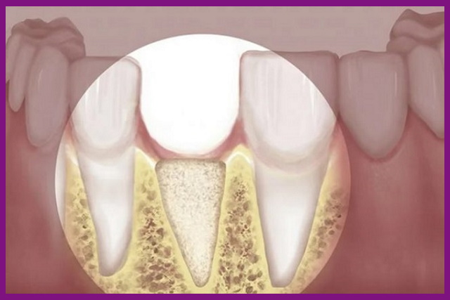 cấy ghép implant sẽ giúp ngăn ngừa được tình trạng tiêu xương, teo xương hàm do mất răng gây ra