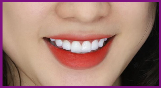 răng sứ implant có độ trắng sáng, đều đẹp tự nhiên như răng thật, giúp người bệnh có ngay một hàm răng thu hút người đối diện