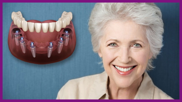 cấy ghép implant là loại phục hình răng cấy trực tiếp trụ implant vào xương hàm của người mất răng