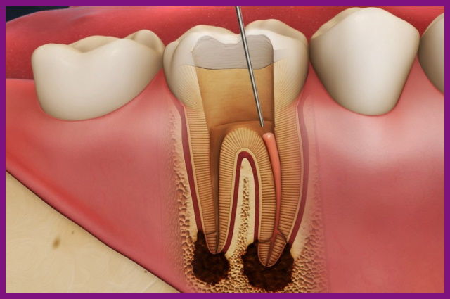 lấy tủy viêm là phương pháp điều trị tủy răng hiệu quả nhất hiện nay