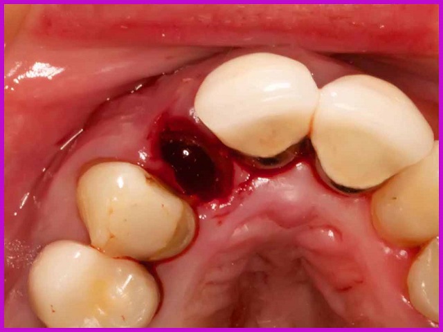 phương pháp điều trị tuỷ răng bằng nhổ răng