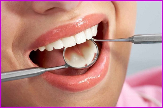 phương pháp điều trị tuỷ răng tốt nhất
