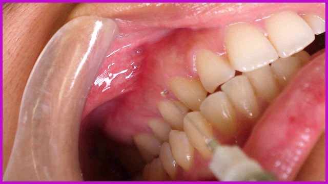 phương pháp điều trị tuỷ răng tphcm