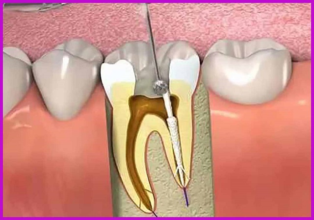 rút tuỷ răng và sức khoẻ răng miệng