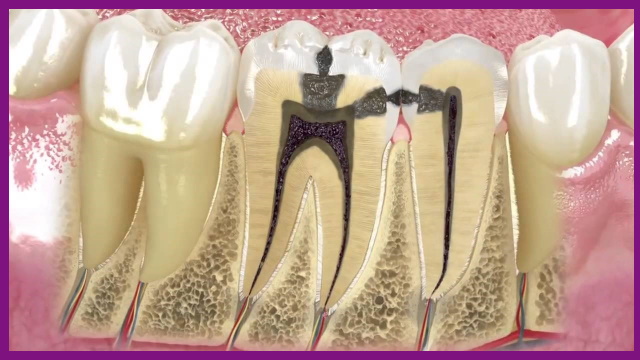 sâu răng viêm tủy dễ dẫn đến hoại tử tủy răng